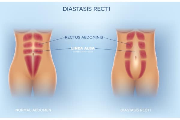 What Non-Surgical Options Are Available for Diastasis Recti Allesley Green?