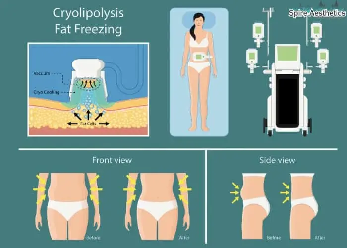 Fat freezing treatment Allesley Green benefits for competitions to remove stubborn fat deposits.